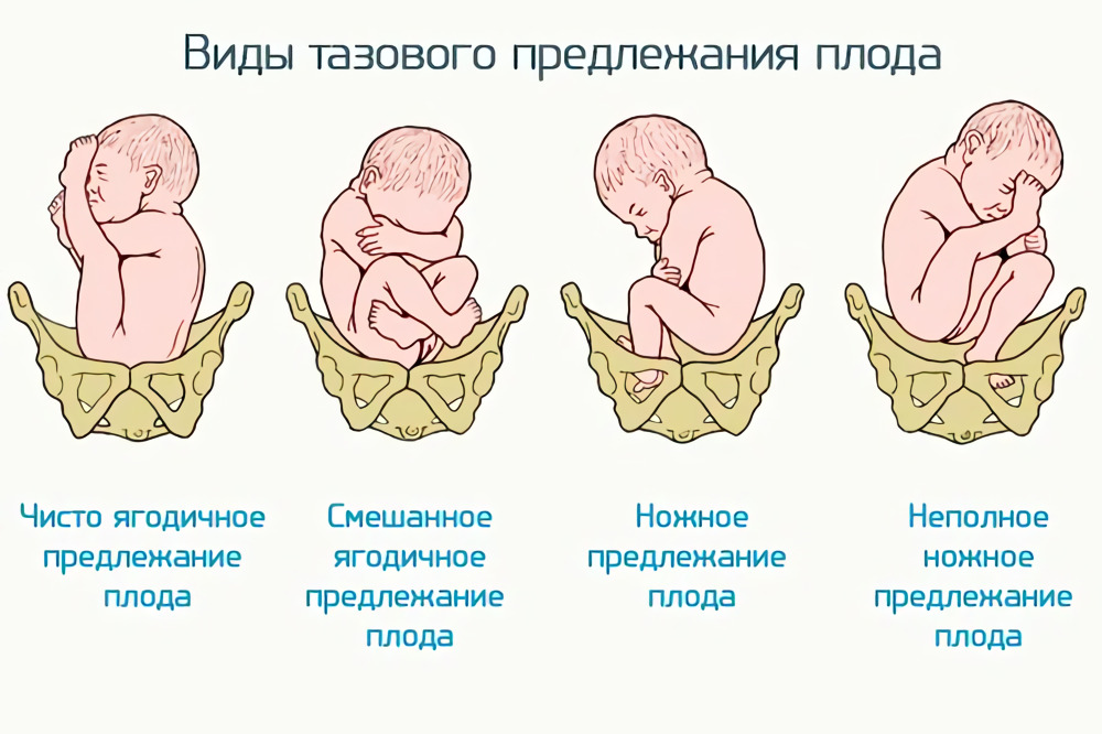 Пологи при тазовому передлежанні плоду