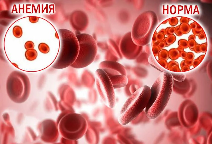 Анемія у людей похилого віку