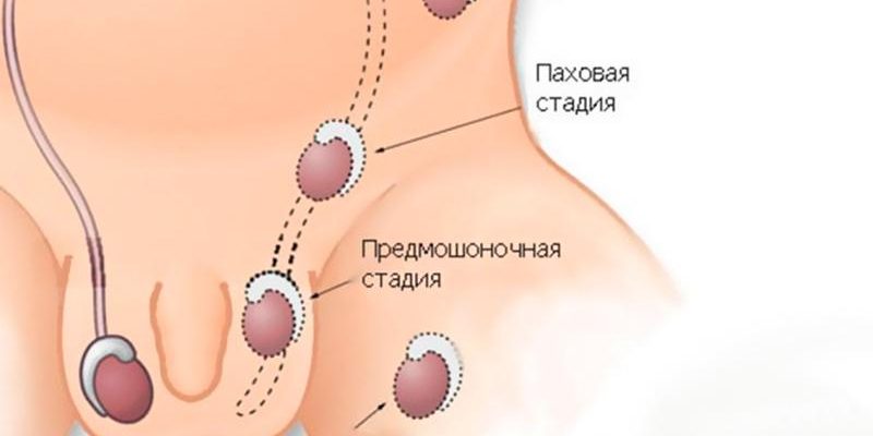 Крипторхізм