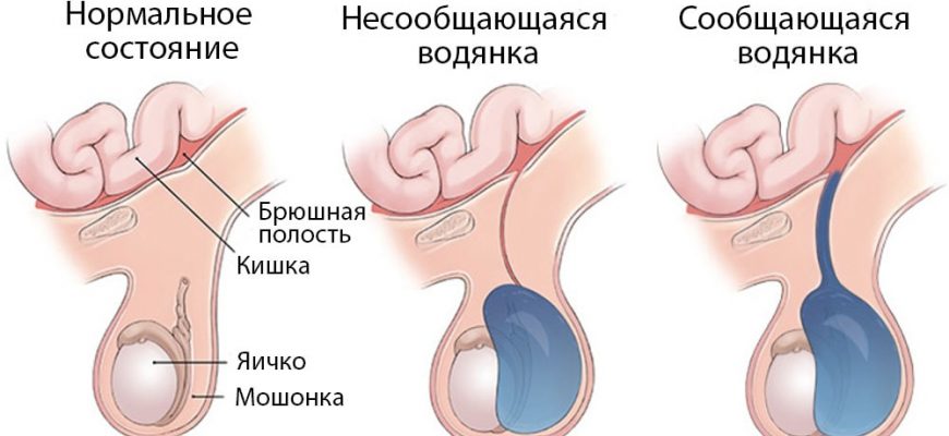 Водянка яєчка