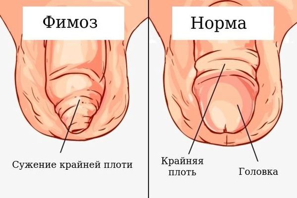 Фімоз