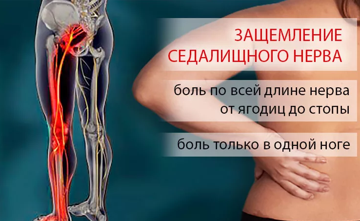 Защемлення сідничного нерва: симптоми, ознаки та причини, діагностика та лікування