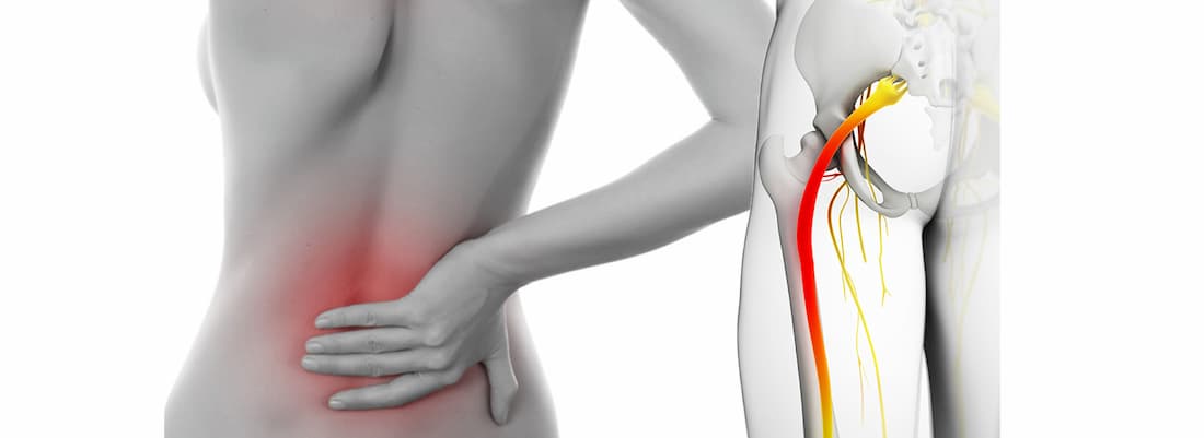 Защемлення сідничного нерва: симптоми, ознаки та причини, діагностика та лікування