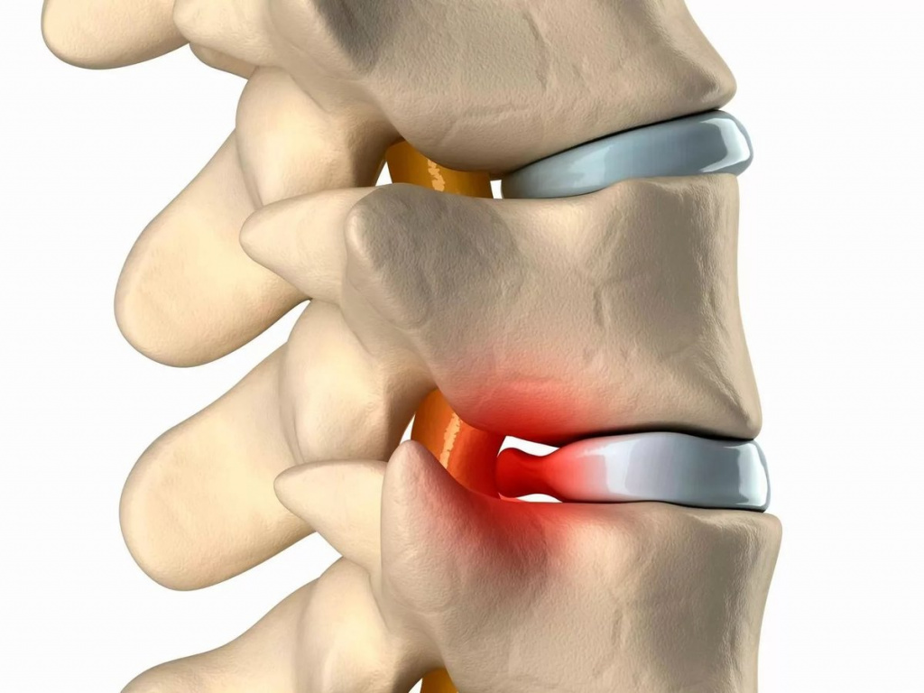 Грижа Шморля: симптоми, ознаки та причини, діагностика та лікування
