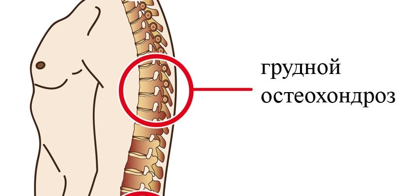Остеохондроз хребта