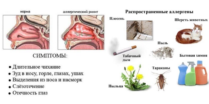 Алергічний риніт – симптоми та лікування нежитю