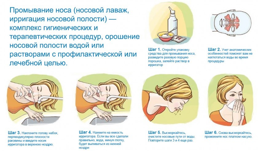 Алергічний риніт – симптоми та лікування нежитю