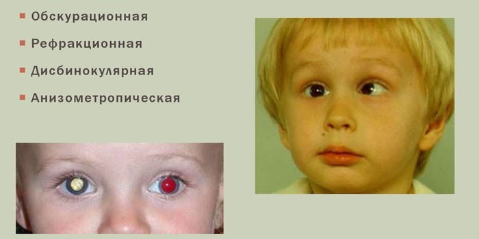 Амбліопія у дорослих та дітей: ступеня хвороби та лікування