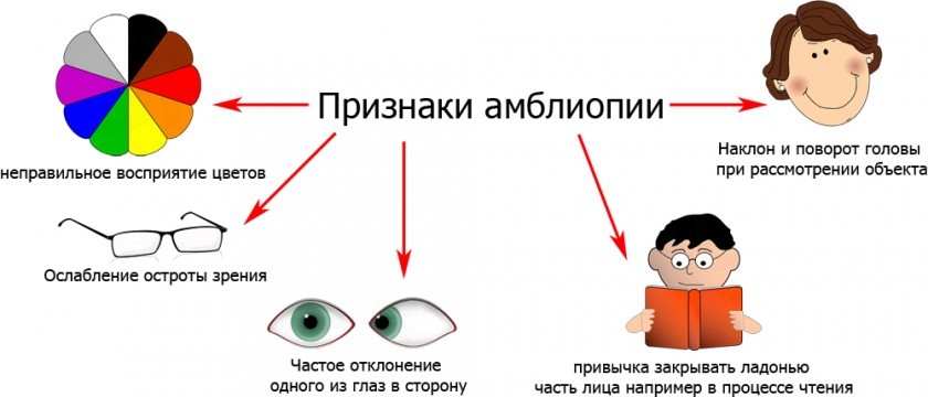 Амбліопія у дорослих та дітей: ступеня хвороби та лікування