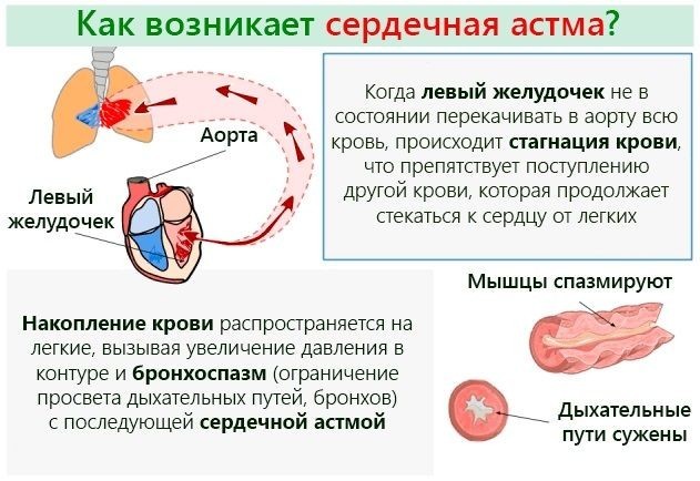 Астма – симптоми та лікування у дорослих та дітей