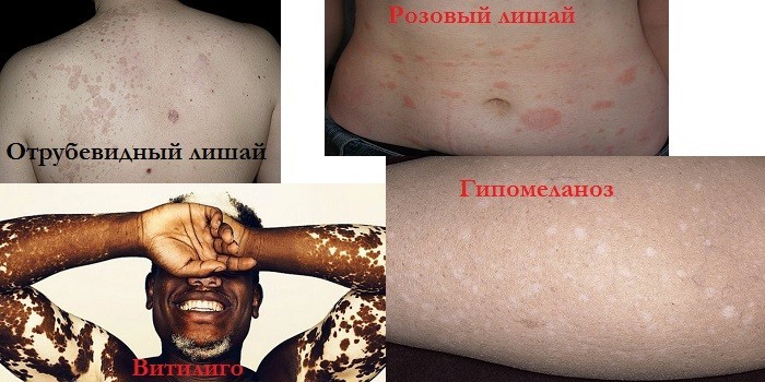 Бляшки на шкірі - чому утворюються і методи рятування