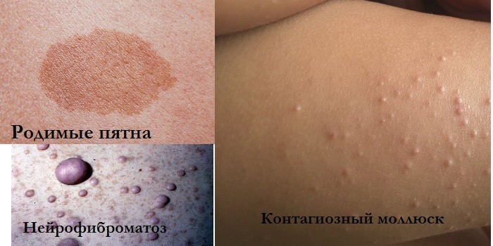 Бляшки на шкірі - чому утворюються і методи рятування