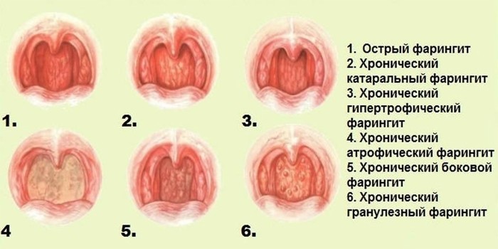 Хвороби горла та гортані - грибкові. бактеріальні, вірусні