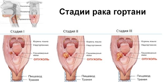 Хвороби горла та гортані - грибкові. бактеріальні, вірусні
