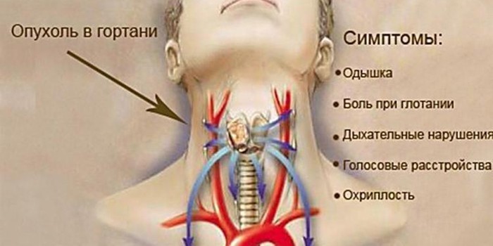 Хвороби горла та гортані - грибкові. бактеріальні, вірусні
