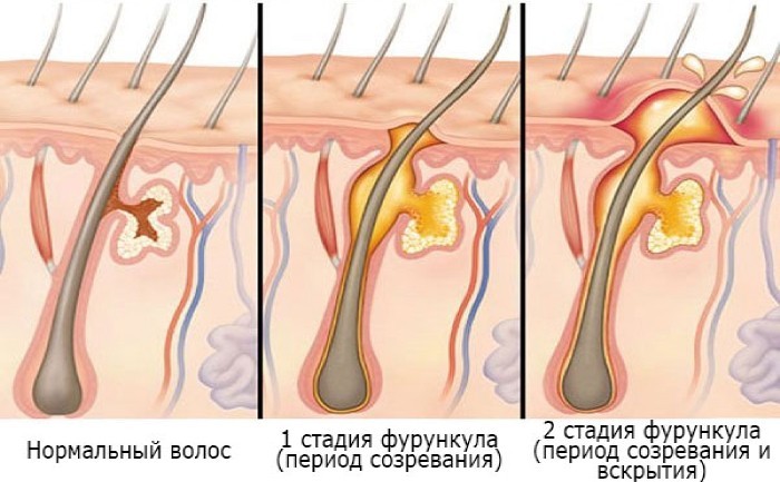 Чирьи - що це таке, лікування фурункульозу в домашніх умовах та у лікаря
