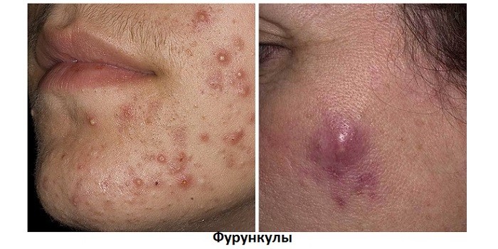 Чирьи - що це таке, лікування фурункульозу в домашніх умовах та у лікаря