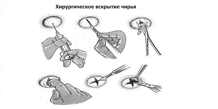 Чирьи - що це таке, лікування фурункульозу в домашніх умовах та у лікаря