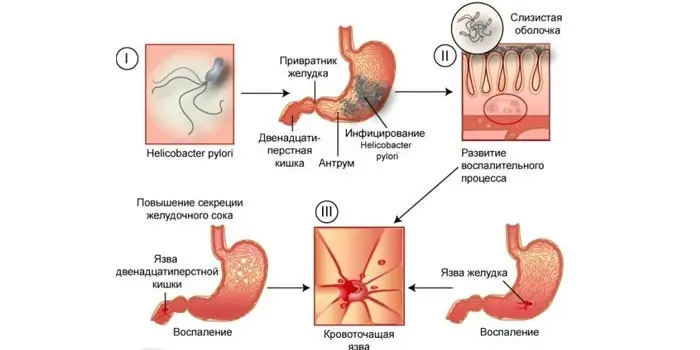 Причини виникнення виразки шлунка - стрес та провокуючі хвороби