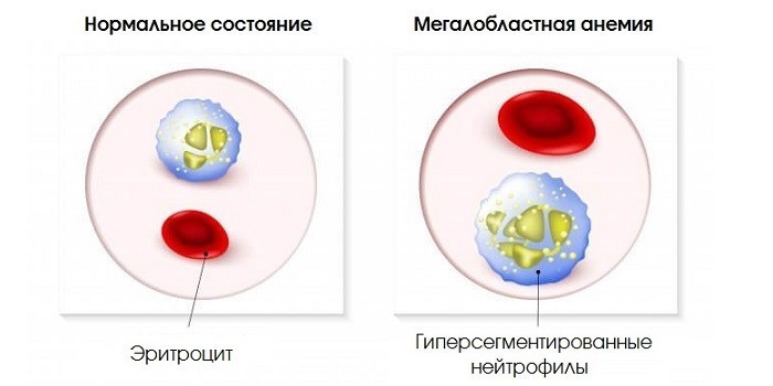 Дефіцит вітаміну В12 - ознаки у дітей, жінок та чоловіків