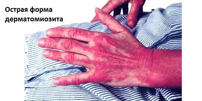 Дерматоміозит: ознаки та клінічні рекомендації при хворобі Вагнера