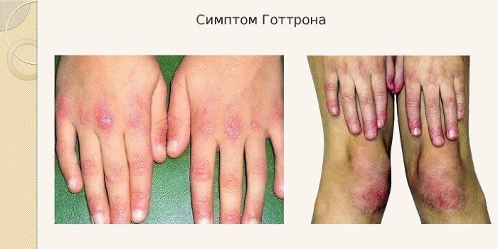 Дерматоміозит: ознаки та клінічні рекомендації при хворобі Вагнера