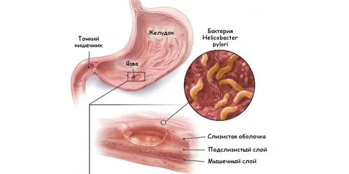 Діагностика виразки шлунка - за якими симптомами виявляють захворювання