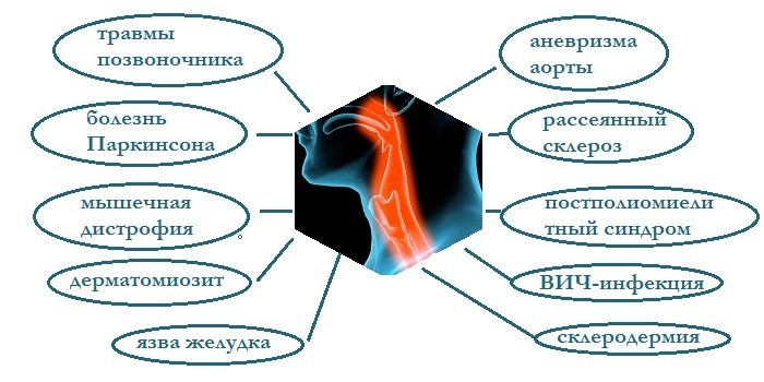 Дисфагія у дітей та дорослих - діагностика, ступеня та як лікувати