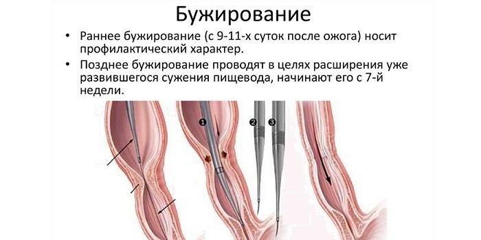 Дисфагія у дітей та дорослих - діагностика, ступеня та як лікувати