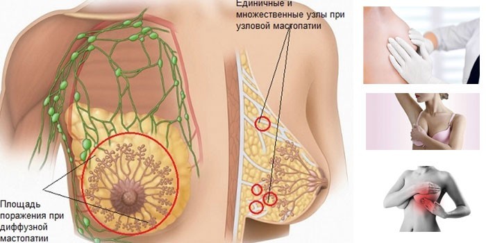 Фіброзно-кістозна мастопатія - як лікувати народними засобами, препаратами