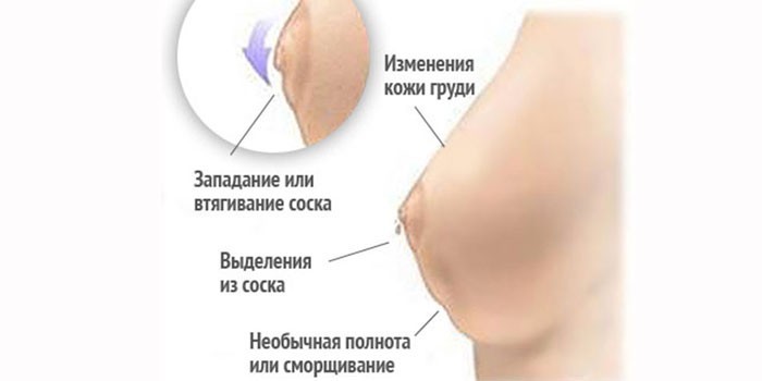 Фіброзно-кістозна мастопатія - як лікувати народними засобами, препаратами