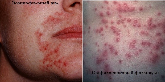 Фолікуліт у дітей та дорослих - види і як лікувати