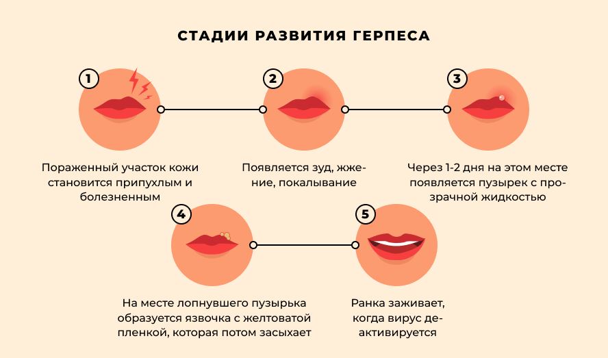 Початкова стадія Герпесу на губах.