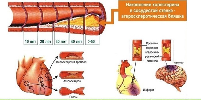 Гіпертонія 2 ступеня - як лікувати медикаментами та народними засобами