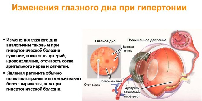 Гіпертонія 2 ступеня - як лікувати медикаментами та народними засобами