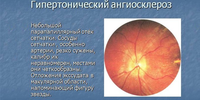 Гіпертонія 2 ступеня - як лікувати медикаментами та народними засобами