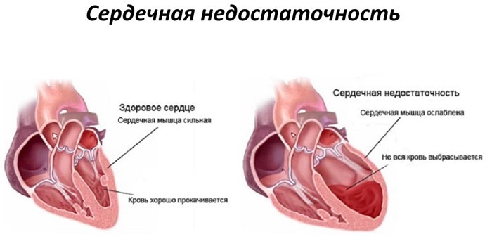 Гіпертонія 2 ступеня - як лікувати медикаментами та народними засобами