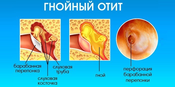 Гнійний отит гострий та хронічний – ознаки та як лікувати в домашніх умовах