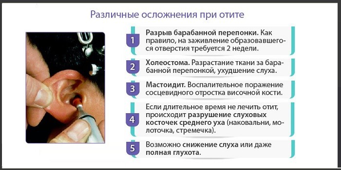 Гнійний отит гострий та хронічний – ознаки та як лікувати в домашніх умовах