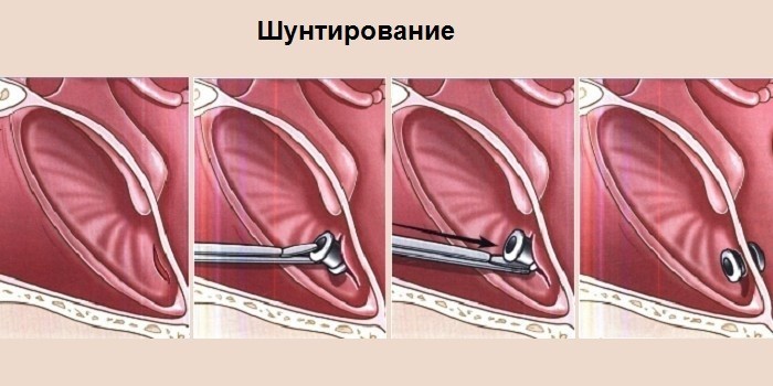 Гнійний отит гострий та хронічний – ознаки та як лікувати в домашніх умовах