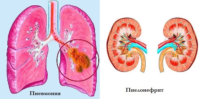 Грип при вагітності - як лікувати препаратами та народними засобами