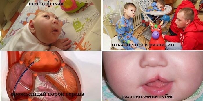 Грип при вагітності - як лікувати препаратами та народними засобами