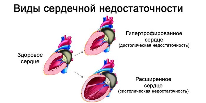 Хронічна серцева недостатність - клінічні рекомендації
