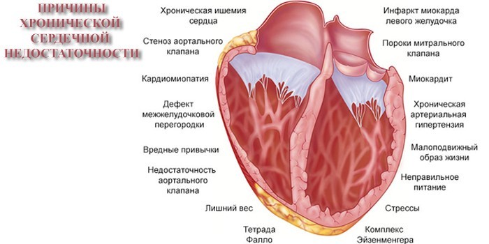 Хронічна серцева недостатність - клінічні рекомендації