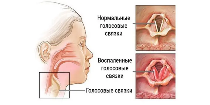 Хвороби голосових зв'язок у дутів та дорослих - методи терапії та відновлення