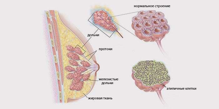 Інвазивний рак молочної залози протоковий, неспецифічний та дольковий