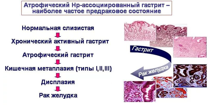 Як лікувати хронічний атрофічний гастрит