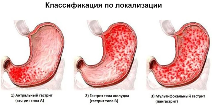 Як лікувати хронічний атрофічний гастрит