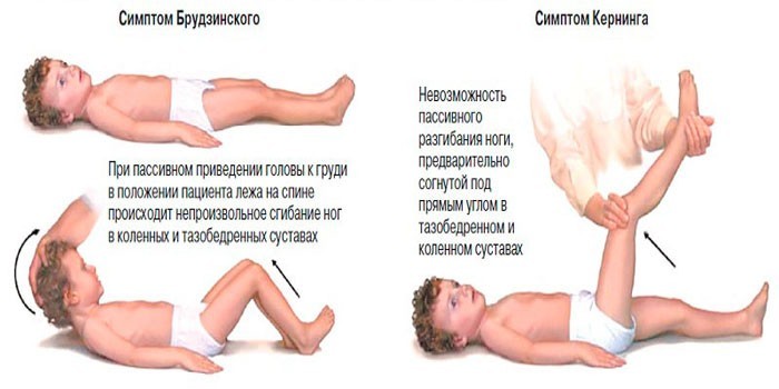Як розпізнати менінгіт у дитини в домашніх умовах