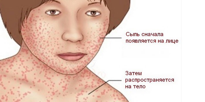 Як розпізнати менінгіт у дитини в домашніх умовах